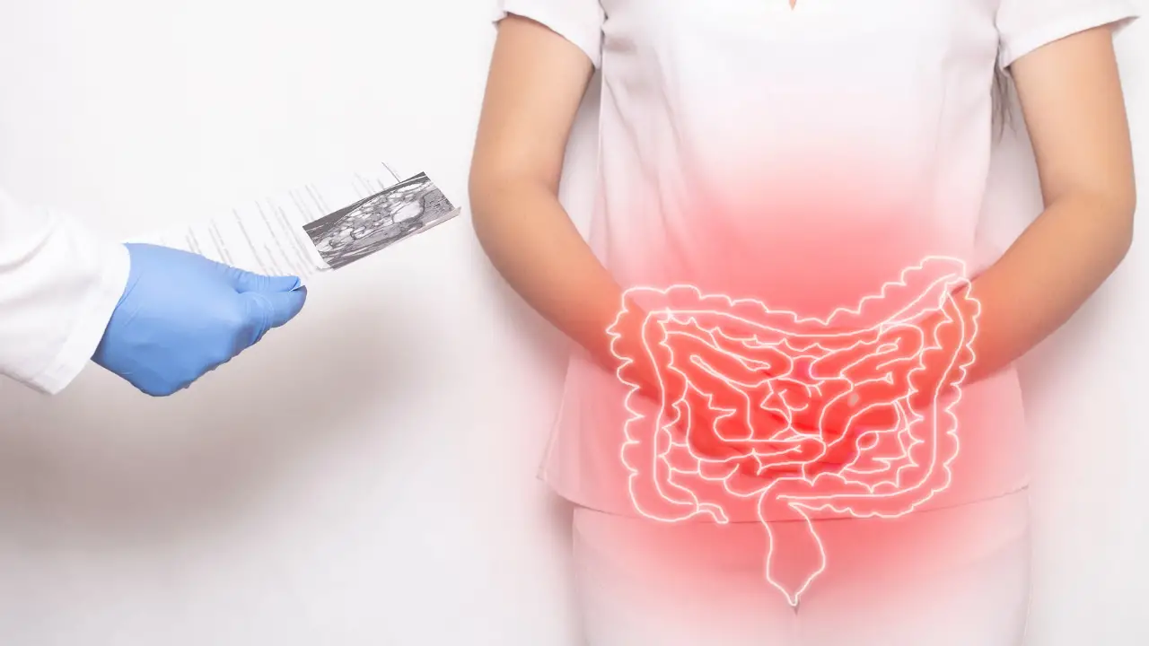 Understanding the Risk Factors for Colon Cancer